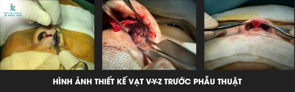 Hình ảnh thiết kế vạt V-Y-Z trước phẫu thuật.