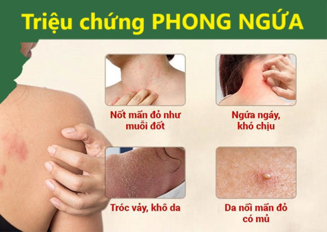 Quản lý và phục hồi chức năng cho bệnh nhân phong