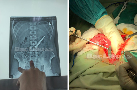 Bệnh viện Đa khoa Bạc Liêu: Phẫu thuật thành công trường hợp bệnh nhân nuốt lưỡi dao vào ổ bụng