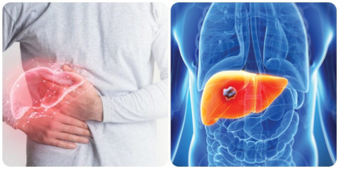Những dấu hiệu cảnh báo ung thư gan giai đoạn sớm