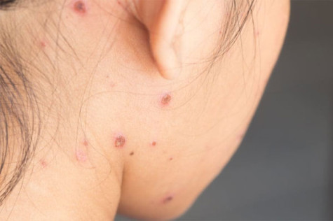 Bệnh thủy đậu và những biến chứng nguy hiểm