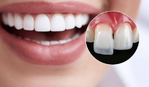 Dán sứ Veneer Emax có thực sự tốt không? Địa chỉ dán sứ uy tín?