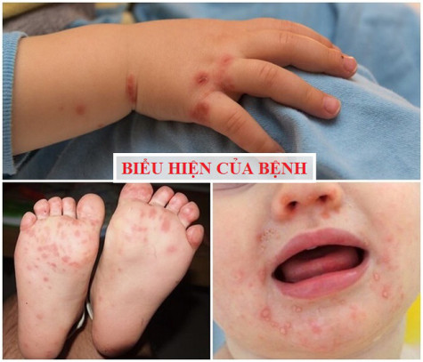 Hãy chủ động phòng ngừa bệnh tay chân miệng