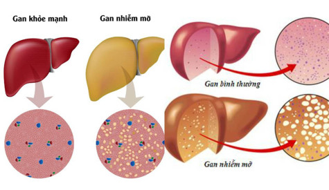 Yếu tố nguy cơ gây gan nhiễm mỡ