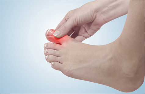 Phòng ngừa bệnh gout