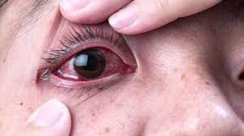 BỆNH ĐAU MẮT ĐỎ