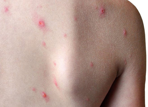 Cẩn thận với bệnh đậu mùa khỉ