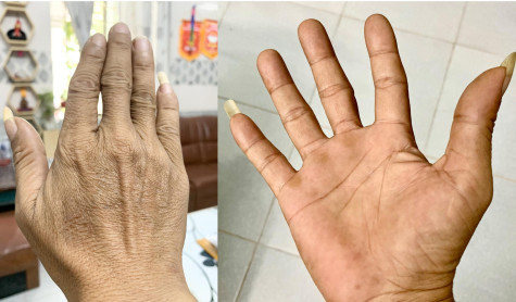 Dấu hiệu trên tay cho biết tình trạng sức khỏe lá gan