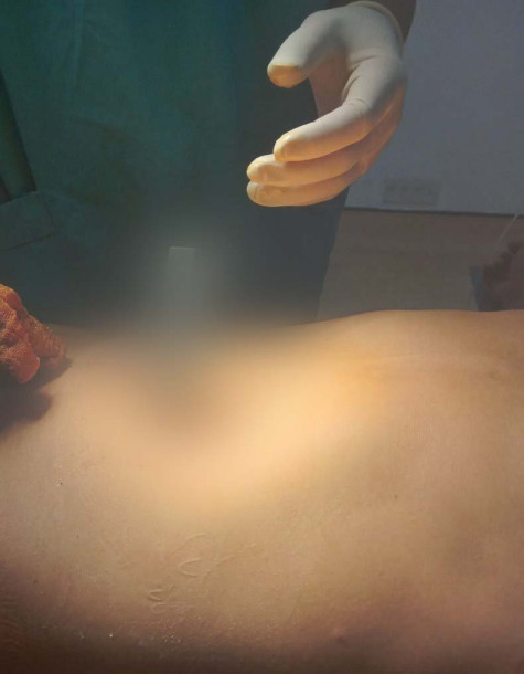 Bệnh viện Đa khoa Bạc Liêu: Cứu sống thanh niên tự đâm thủng bụng mình