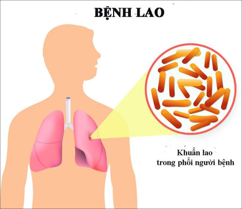 Cộng đồng đoàn kết, quyết tâm hướng tới một thế giới không còn bệnh lao