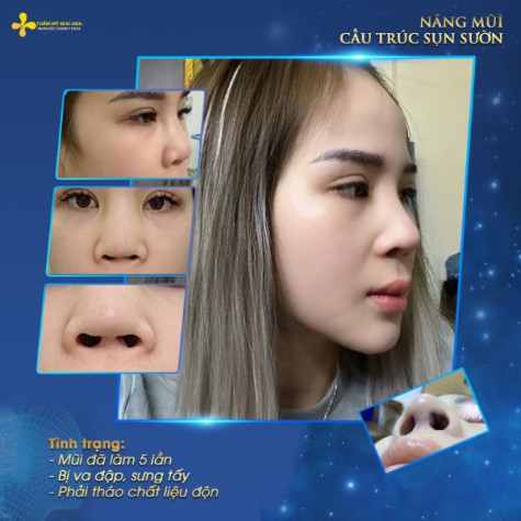 Nâng mũi bằng sụn tự thân có tốt không? Có nên nâng mũi bằng sụn tự thân