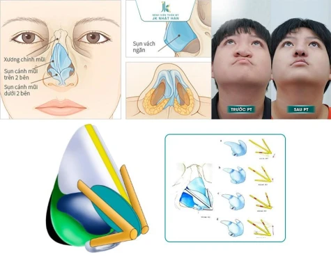 Ứng dụng kỹ thuật V-Y-Z độc quyền trong tạo hình mũi dị tật của bác sĩ Lê Viết Trí