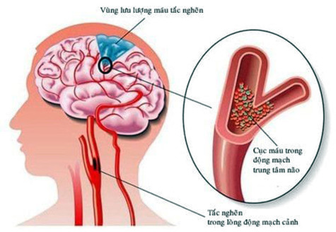 Phòng tránh bệnh đột quỵ