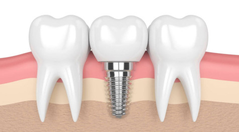 Cấy răng implant và bảng giá trồng răng hiện nay