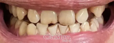 Thuốc lá gây nhiều bệnh lý về răng miệng