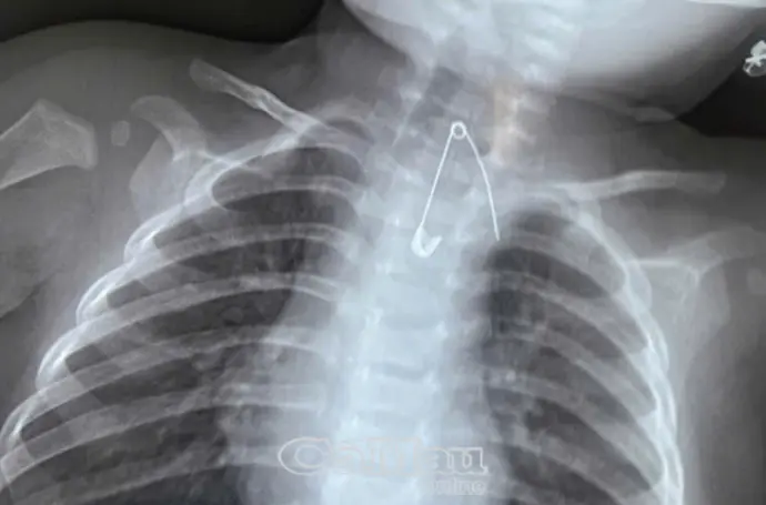 Bé 7 tháng tuổi nuốt kim tây: Cảnh báo nguy cơ dị vật ở trẻ nhỏ