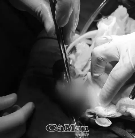 Phẫu thuật khẩn cấp trường hợp bệnh nhân bị gãy dương vật