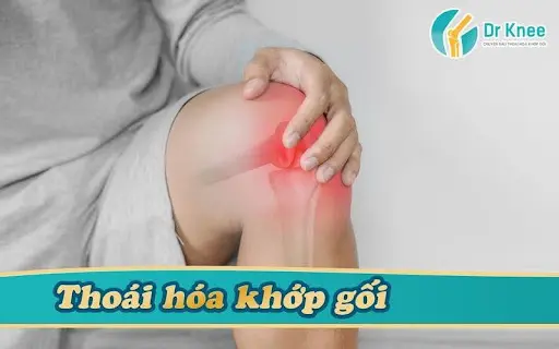 Nhận Diện Sớm Triệu Chứng Thoái Hóa Khớp Gối: Cách Vận Động Để Bảo Tồn Khớp Bền Vững