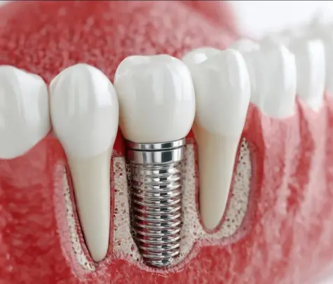 Trồng Implant bao lâu thì ăn nhai bình thường?